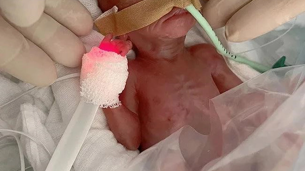 Acest nou-născut a sfidat moartea! Un bebeluș de 300 de grame a supraviețuit după ce a venit pe lume cu 16 săptămâni mai devreme