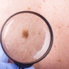 Cancerul, cea mai frecventă cauză de deces în lume. Care sunt factorii care duc la această boală