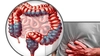 Primele simptome ale cancerului colorectal! Ce ar trebui să știm pentru a-l preveni