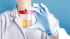 Ce afli dintr-un sumar de urină și urocultură și care este prețul, de fapt? Două analize care pot preveni complicații grave!