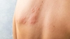 Cum identifici alergiile de la căldură? 5 poze care spun tot!