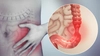 Ce este sindromul intestinului iritabil? Iată ce complicații pot apărea!