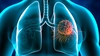 Ce este un abces pulmonar? Află ce consecințe poate avea asupra sănătății!