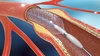 Prețul real pentru montare de stent la inimă și ce factori pot influența schimbărea acestuia