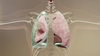 În cât timp se vindecă pneumotoraxul? Iată tot ce trebuie să știi despre recuperare
