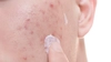 Se folosește crema hidratantă dacă ai ten acneic? Iată tot ce trebuie să știi!