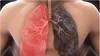 Cancer la plămâni – Simptome, cauze și diagnostic