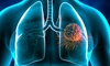 Ce este un abces pulmonar? Află ce consecințe poate avea asupra sănătății!