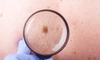 Cancerul, cea mai frecventă cauză de deces în lume. Care sunt factorii care duc la această boală