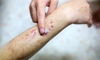 Purpura fulminans, o afecțiune medicală severă și rară! Iată la ce simptome trebuie să fii atent!
