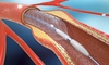 Prețul real pentru montare de stent la inimă și ce factori pot influența schimbărea acestuia