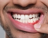 Gel pentru gingii. Care sunt cele mai eficiente soluții pentru tratarea inflamației gingivale