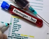 Medicamente pentru scăderea fibrinogenului. Care pot fi afecțiunile din spatele unui nivel ridicat