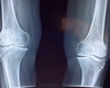 Radiografia de genunchi – În ce situații se face și cum se efectuează procedura?