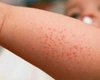 Rujeola revine în forță în SUA, dar miturile despre vaccin o sabotează. Un sfert dintre părinți au amânat imunizarea copiilor