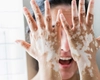 Vitiligo și cauzele sale! Iată cine este afectat și de ce!