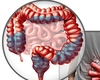 Primele simptome ale cancerului colorectal! Ce ar trebui să știm pentru a-l preveni
