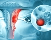 În cât timp se dezvoltă cancerul ovarian? Iată cum poți preveni această afecțiune!