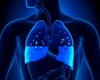 Edem pulmonar. Șanse de supraviețuire și cât de grave sunt simptomele