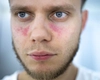 Lupus eritematos sistemic, boala diagnosticată mult prea târziu! Iată ce simptome „trădează” această afecțiune!