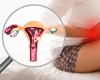 Endometru îngroșat, ce trebuie să știm? Află când ar trebui mers la medic!