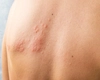 Cum identifici alergiile de la căldură? 5 poze care spun tot!