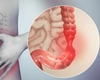 Ce este sindromul intestinului iritabil? Iată ce complicații pot apărea!