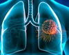 Ce este un abces pulmonar? Află ce consecințe poate avea asupra sănătății!