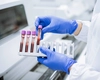 Pot analizele de sânge să depisteze scleroza multiplă? Iată ce trebuie să știi pentru diagnostic