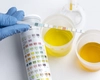 Culoarea schimbată a urinei în hepatită, ce poate indica și când ar trebui să apelezi la medic? Iată ce modificări apar!