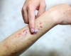 Purpura fulminans, o afecțiune medicală severă și rară! Iată la ce simptome trebuie să fii atent!