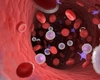Leucemia acută este o formă gravă de cancer al sângelui, care necesită tratament imediat!