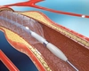 Prețul real pentru montare de stent la inimă și ce factori pot influența schimbărea acestuia