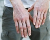 Cum arată psoriazis la început. Iată la ce simptome trebuie să fii atent!