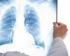 Toate persoanele de peste 18 ani pot beneficia, de la 1 iulie, de radiografii pulmonare gratuite! Trebuie doar să se prezinte la medic cu o copie a cărții de identitate