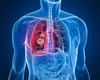 TBC simptome, cauze și tratament. Cum să recunoști tuberculoza înainte să devină gravă