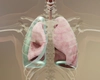 În cât timp se vindecă pneumotoraxul? Iată tot ce trebuie să știi despre recuperare