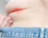 Intertrigo, o afecțiune ușoară, dar cu complicații serioase! Iată cum se poate preveni!