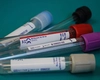 Infecțiile care scad numărul de limfocite! Ce boli se pot ascunde în spatele acestor valori