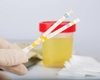 Prezența nitriților pozitivi în urină, semn de infecție? Iată care sunt cauzele!