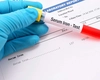 Care sunt cauzele care duc la o sideremie mică? Iată cum pot influența afecțiunile hepatice!