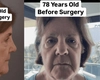 O femeie de 78 de ani s-a transformat spectaculos după o operație estetică. Procedura a durat aproximativ opt ore
