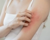 Ce este dermatita miozita? Iată ce trebuie să știi despre boala rară care afectează mușchii și pielea