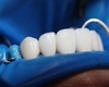 Dinți de zirconiu. Iată de ce este apreciat acest material pentru refacerea danturii