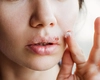 Cu ce trece herpesul mai repede? Iată cum îl poți estompa peste noapte!