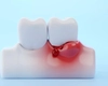 Gingiile care sângerează la periaj: ce înseamnă și când trebuie să mergeți la dentist