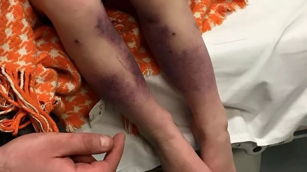 Aceasta fetita s-a trezit cu picioarele pline de vanatai Cand a ajuns la spital medicii i-au dat o veste ingrozitoare