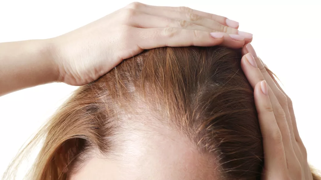 Alopecia cand căderea părului devine o boala grava