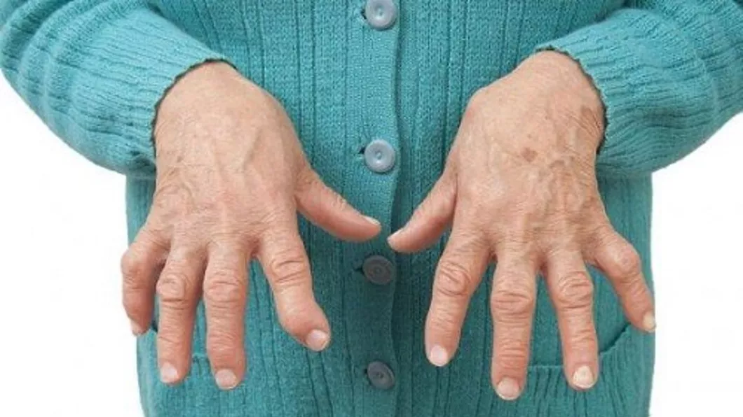 De ce apare artrita reumatoidă