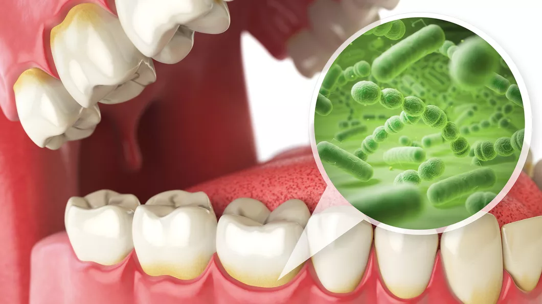 Bacteriile orale si sanatatea creierului. Descopera ce bacterie din gura iti poate distruge creierul
